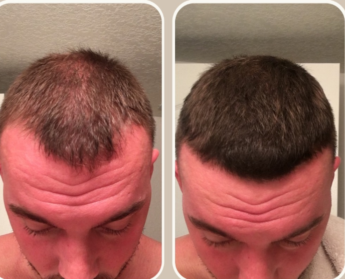 Noticeably thicker, fuller hair growth after using the promoted hair serum.